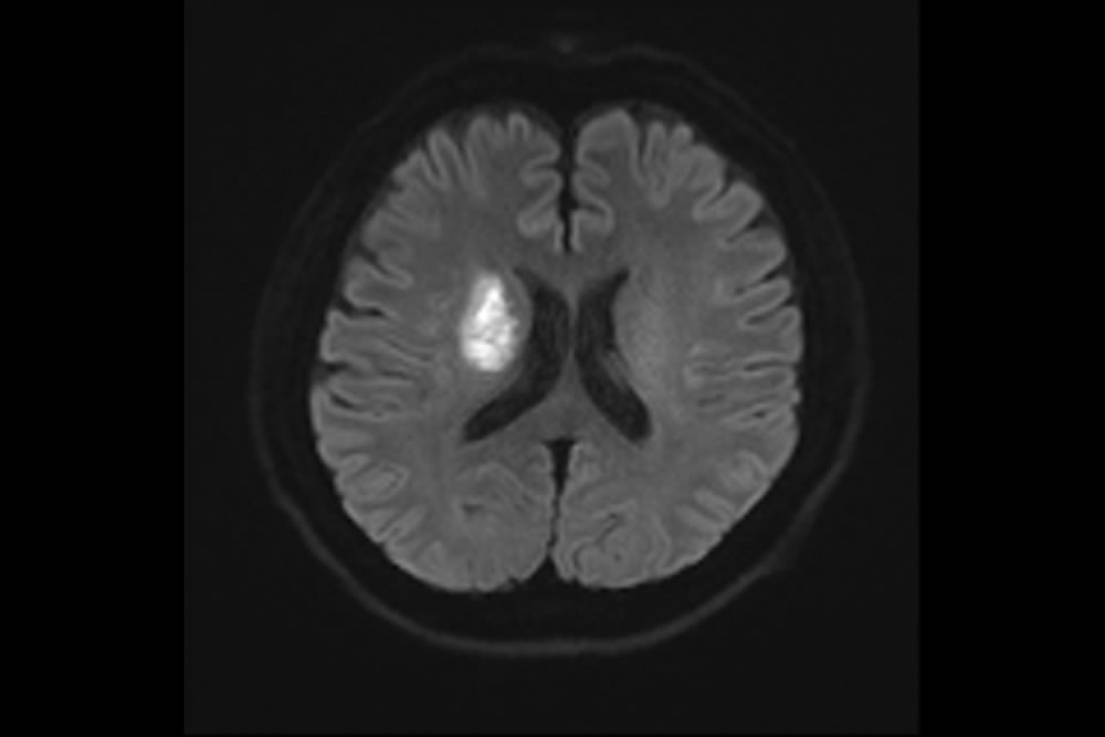 拡散強調画像（脳梗塞）