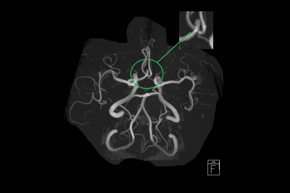 頭部MRA（動脈瘤）