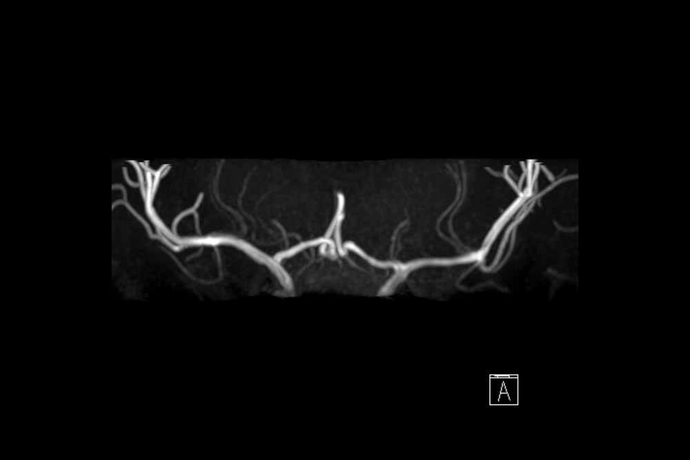 頭部MRA（穿通枝）