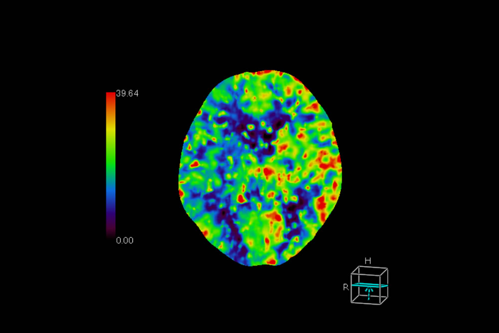 CT-Perfusion