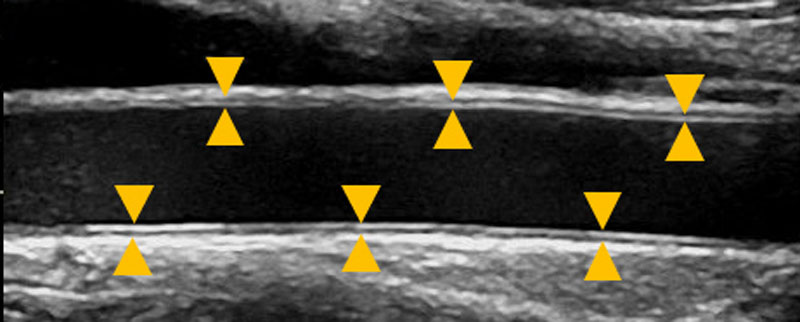 正常な血管の超音波画像。（▲は血管壁を示します）